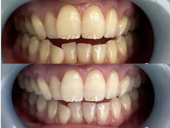 アーティ(aaty)/セルフホワイトニング/白い歯