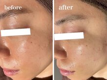 イリゼ(iriser)/ハーブピーリングBeforeAfter