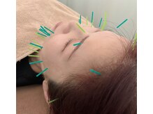 たんぽぽ整骨院鍼灸院の雰囲気（美肌を目指すなら美容はり♪♪）