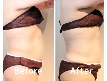 美活ラボ(美活LABO)/ビフォーアフター