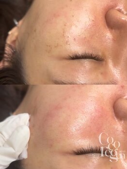 アリビオ(ALIVIO)/韓国最新シミケア☆COCOREGEN☆