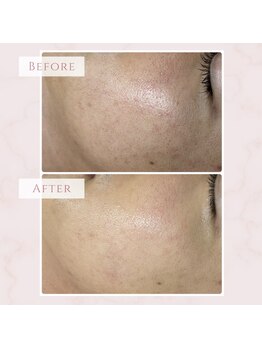 ベベ 福井丸岡店(Be'be')/プレミアム光フェイシャル