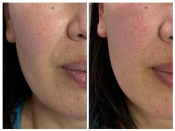 恵比寿脱毛 シーズ(She’s)/ソフトダーマ40代ビフォア