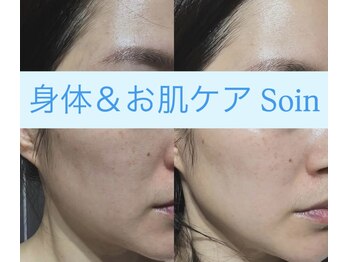 ソアン(Soin)/短時間で即効性あり