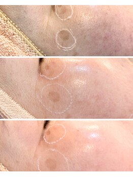 ヒーリングリゾート ナゴミ(Nagomi)の写真/《ナゴミ式シミケア》5年後の肌は、今どれだけケアしたかで“変わる”未来の肌まで考えた本格予防美容♪