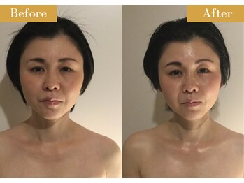 モモスパ(MOMOspa.)/頭蓋骨小顔矯正ビフォアフター