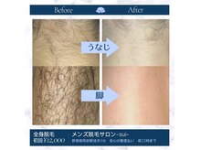 濃い髭や体毛も効果を実感していただけます。諦めていた方は是非