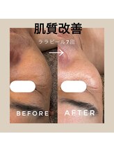 カウニス るる(kaunis)/【ララピール】Before After