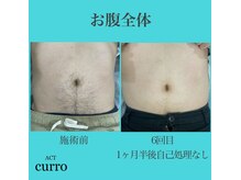 アクト クロ(ACT curro)/【お腹全体】脱毛施術例