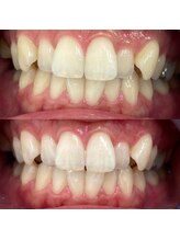 エクシアホワイトニング 日本橋店/初回１回