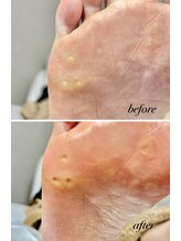 ラヴィ(La vie)/長年タコの悩み