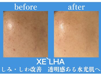 パールホワイトニングサロン 町田店/セラピールでしみ/しわ改善