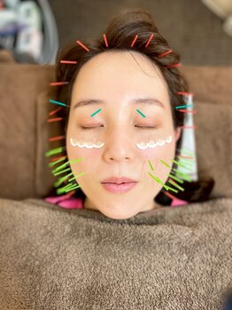 すみれ鍼灸整骨院の写真/小顔矯正＋美容鍼の最強コースで10年前の自分を超えるお顔へ☆シャープで明るい印象に変えませんか？
