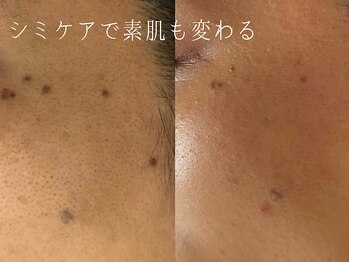 サロンドシエル カスガイ(Salon de Ciel kasugai)/シミケアで土台も変わる