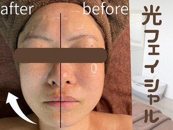 ラグレ(LUXRE)/光フェイシャル