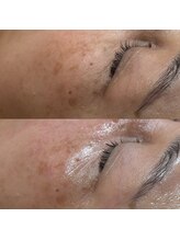 サロン ミジュ(salon MiJU)/NMNピーリング