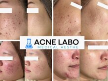 ニキビ・毛穴専門ハーブピーリングACNE LABO 梅田店【3/17 NEW OPEN(予定) 】