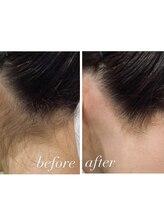 サンゴーハチ(358)&nbsp;光脱毛 