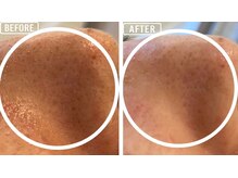 毛穴屋/毛穴に小さな汚れもおまかせ