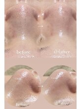 クレヴィー(Creviy)/韓国式3D毛穴洗浄×ハーブ(1回)