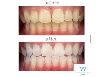 ホワイトニングショップ 山口店/山口ホワイトニング