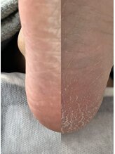 フットミー(foot mii)/かかとケア　１時間ちょっとで