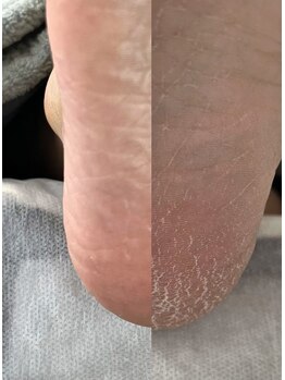 フットミー(foot mii)/かかとケア　１時間ちょっとで