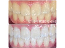 ホワイトニングルーム 横浜店(Whitening Room)/ホワイトニング/横浜
