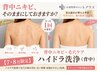 【背中のざらつき・ニキビ】7・8月限定！集中背中ケア×ハイドラ洗浄(背中)