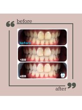 キラット 高知中万々店(Kiratt)/【クリスタルホワイトニング】