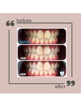 キラット 高知中万々店(Kiratt)/【クリスタルホワイトニング】