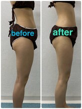 ハロ 南青山(HALO)/全身キャビラジ+太もも脂肪取り