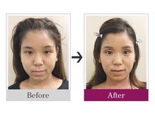 ビコツゼロ 心斎橋(BIKOTSU ZERO)/小顔・むくみ