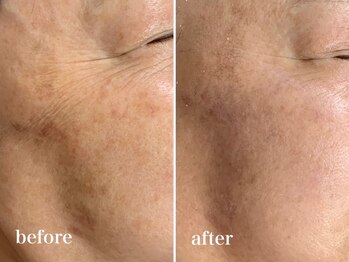 イリゼ(iriser)/ハーブピーリングBeforeAfter