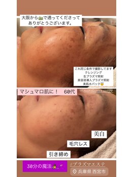 アンジュ/プラズマ１回ビフォーアフター