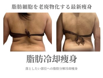 エクラ イオンモール徳島店(ECLAT)/脂肪冷却痩身