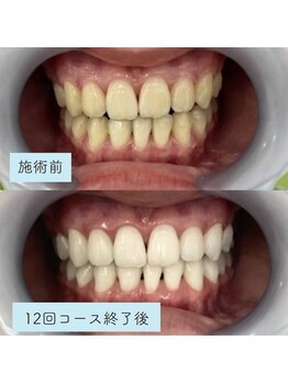 アイブロウ33 久留米店/【ホワイトニングBefore After】