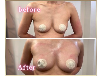 ジュエルリング(Jewel Ring)/症例写真バストアップ