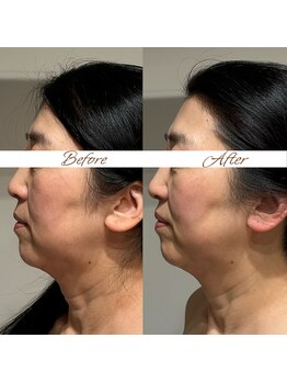 マヌレニ(manuleni)/引き締めで下顔面が変わる