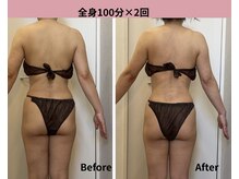 タノソイネ(tanosoine)/【50代/ハイパーナイフ痩身】