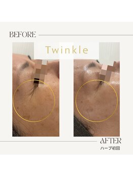 ティンクル(Twinkle)/目尻の小皺