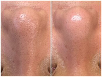 アンドエミニー エン ラボーテ(& EMINY 艶 la beaute)/毛穴洗浄