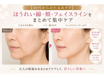 ラシクビューティールームの写真/40代からのほうれい線・たるみが気になる方へ
