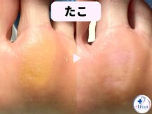 プラスワンフット 本厚木(+1 Foot)/タコ・魚の目ケア！痛みから解放