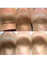 メンズサロンエヌエー(MEN'S SALON NA)/【顔まるごと脱毛】清潔感アップ