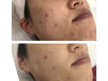 サロンドメネラ(salon de menera)/肌質改善クリスティーナ