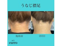 アクト クロ(ACT curro)/【うなじ襟足】脱毛施術例
