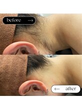 スターチス(Statice)/襟足脱毛　ビフォーアフター