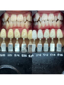 トウキョースワーズ 渋谷店(TOKYO SWRS)/#ホワイトニング #渋谷 #池袋