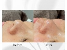 アン ビューティー(ann beauty)/施術1回【症例写真】30代女性